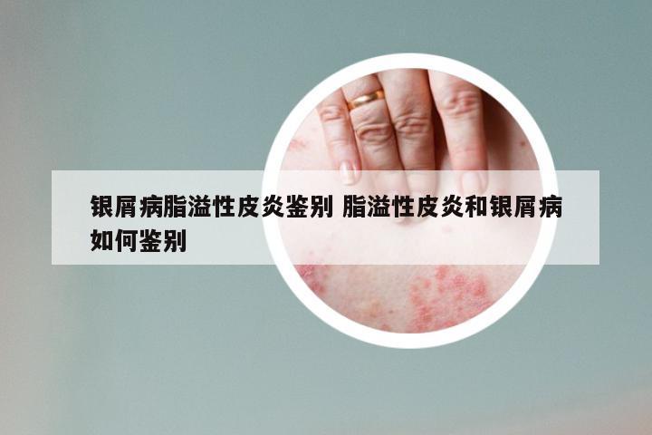 银屑病脂溢性皮炎鉴别 脂溢性皮炎和银屑病如何鉴别