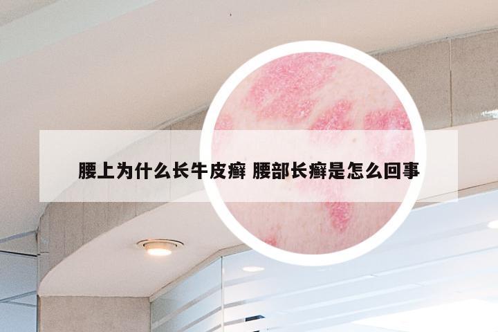 腰上为什么长牛皮癣 腰部长癣是怎么回事