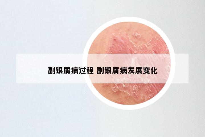 副银屑病过程 副银屑病发展变化