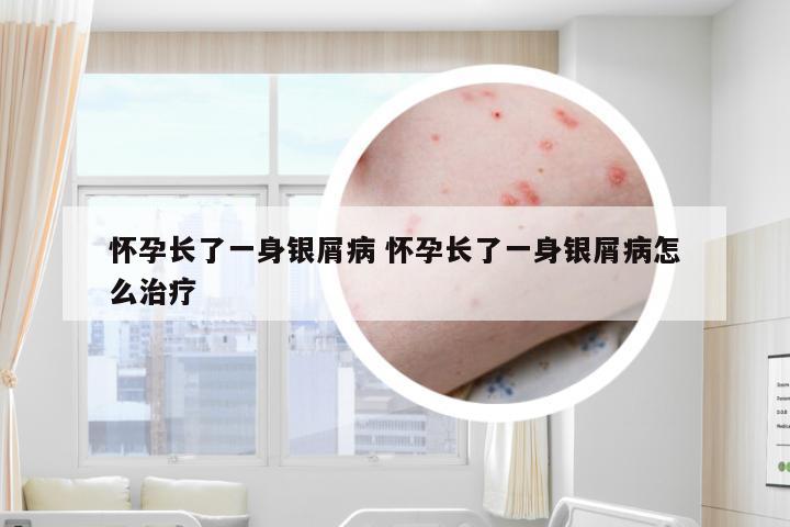 怀孕长了一身银屑病 怀孕长了一身银屑病怎么治疗