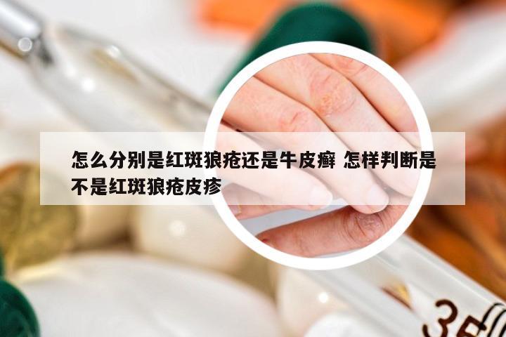 怎么分别是红斑狼疮还是牛皮癣 怎样判断是不是红斑狼疮皮疹