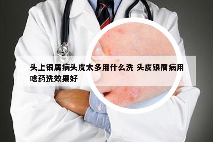 头上银屑病头皮太多用什么洗 头皮银屑病用啥药洗效果好