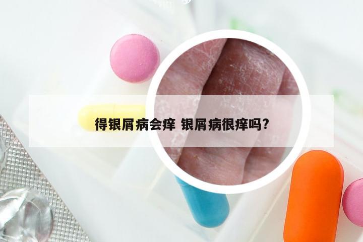 得银屑病会痒 银屑病很痒吗?