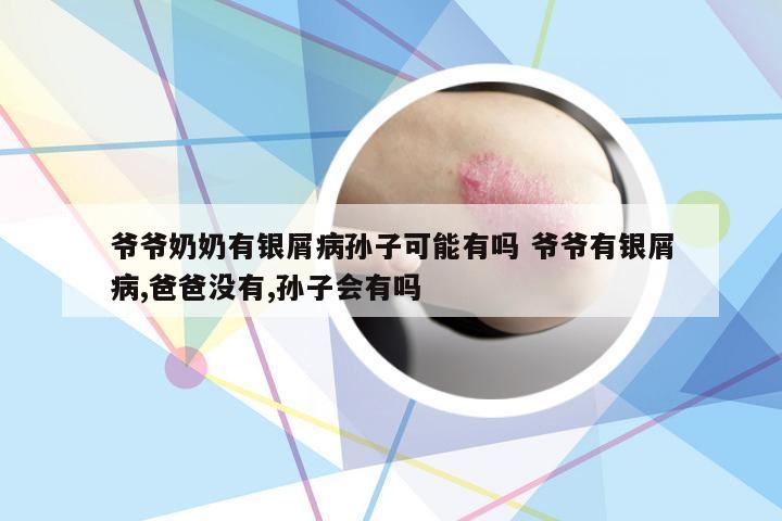 爷爷奶奶有银屑病孙子可能有吗 爷爷有银屑病,爸爸没有,孙子会有吗