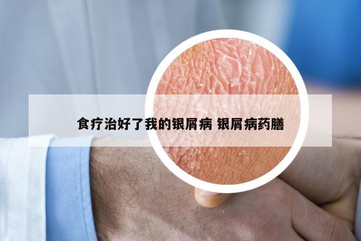 食疗治好了我的银屑病 银屑病药膳