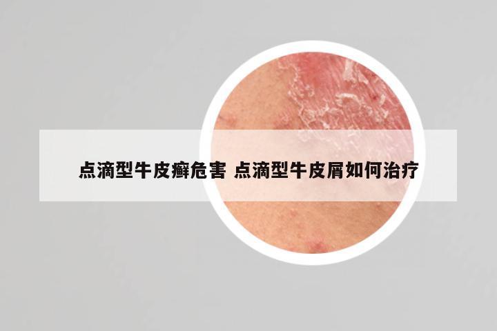 点滴型牛皮癣危害 点滴型牛皮屑如何治疗