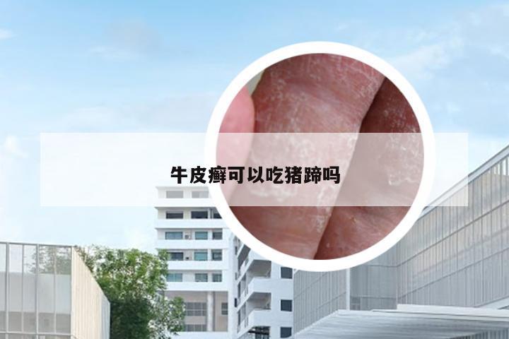 牛皮癣可以吃猪蹄吗