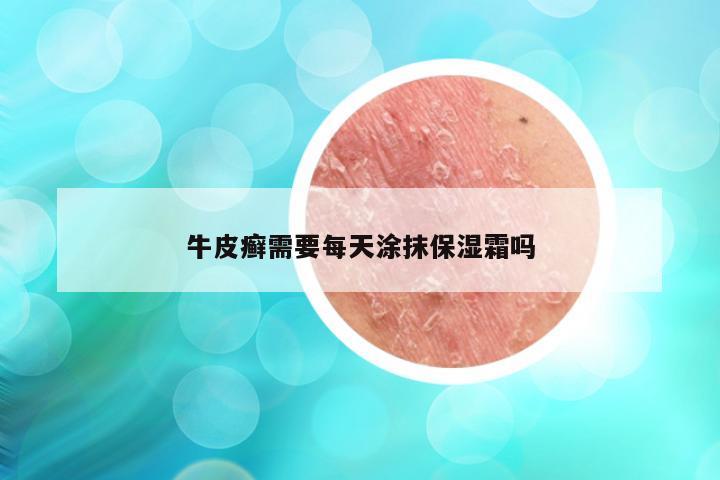 牛皮癣需要每天涂抹保湿霜吗