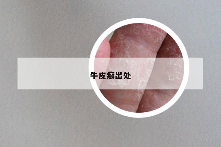 牛皮癣出处