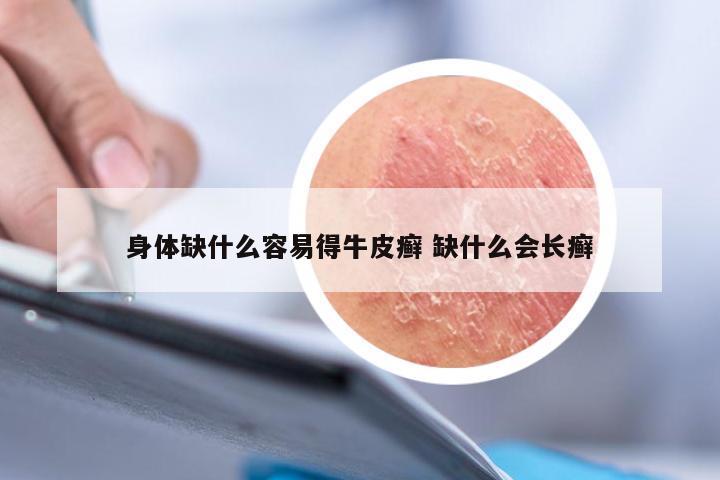 身体缺什么容易得牛皮癣 缺什么会长癣