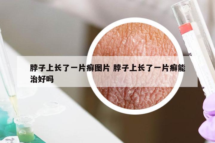 脖子上长了一片癣图片 脖子上长了一片癣能治好吗