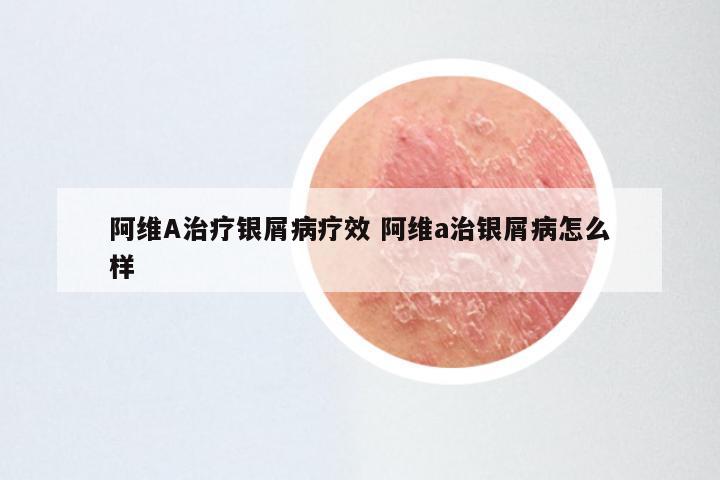 阿维A治疗银屑病疗效 阿维a治银屑病怎么样