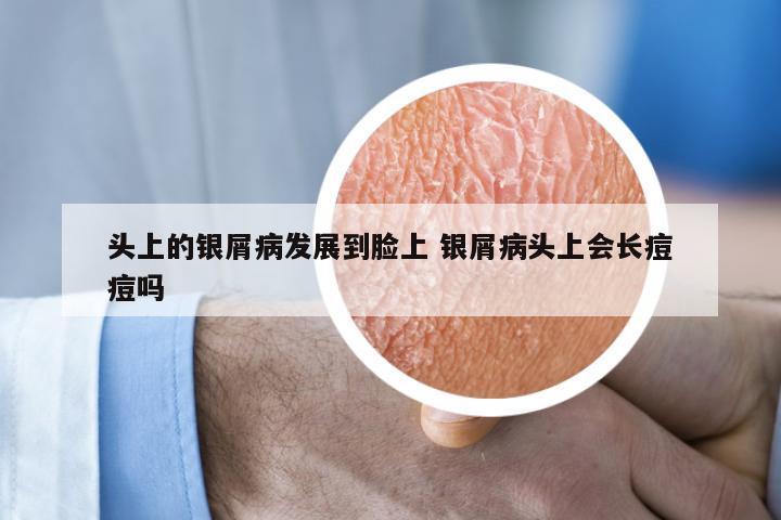 头上的银屑病发展到脸上 银屑病头上会长痘痘吗