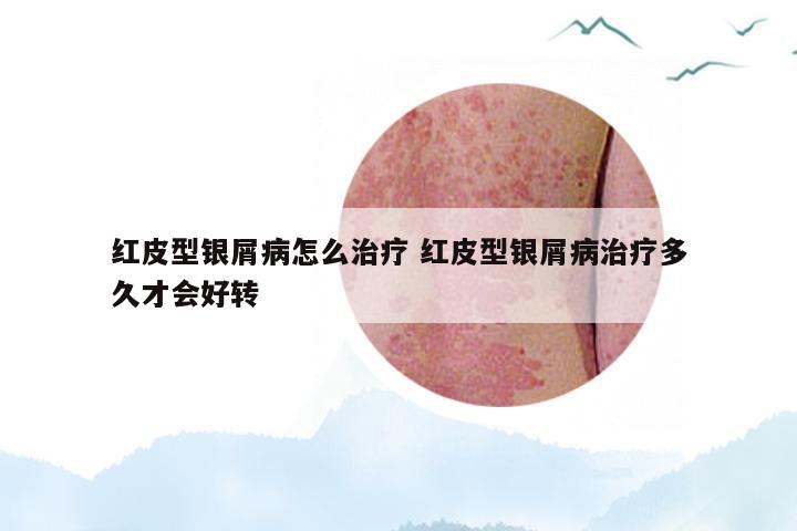 红皮型银屑病怎么治疗 红皮型银屑病治疗多久才会好转