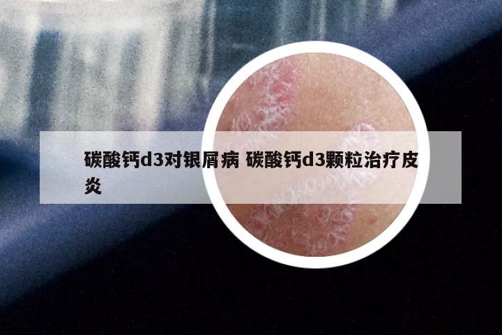 碳酸钙d3对银屑病 碳酸钙d3颗粒治疗皮炎