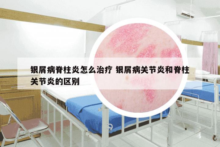 银屑病脊柱炎怎么治疗 银屑病关节炎和脊柱关节炎的区别
