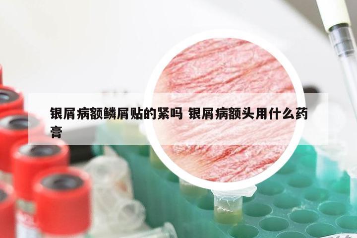 银屑病额鳞屑贴的紧吗 银屑病额头用什么药膏
