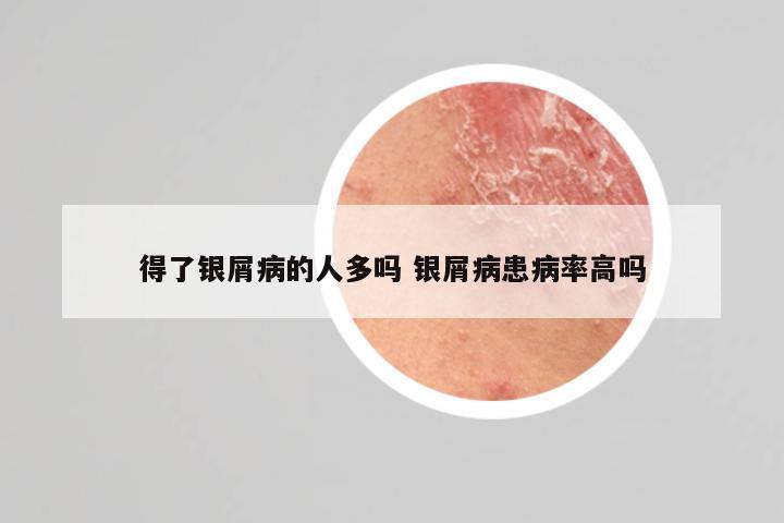 得了银屑病的人多吗 银屑病患病率高吗
