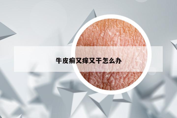 牛皮癣又痒又干怎么办