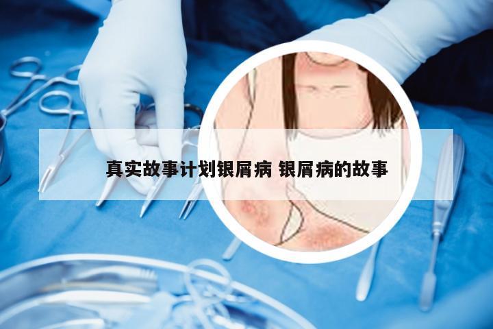 真实故事计划银屑病 银屑病的故事