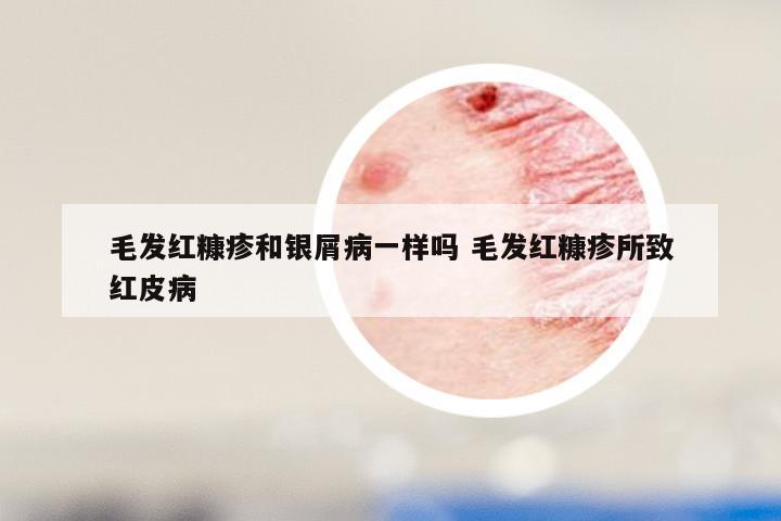 毛发红糠疹和银屑病一样吗 毛发红糠疹所致红皮病