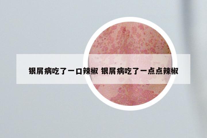 银屑病吃了一口辣椒 银屑病吃了一点点辣椒