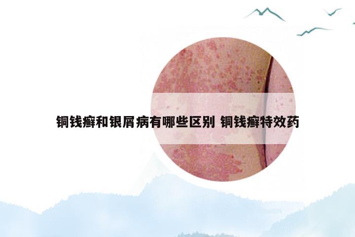 铜钱癣和银屑病有哪些区别 铜钱癣特效药