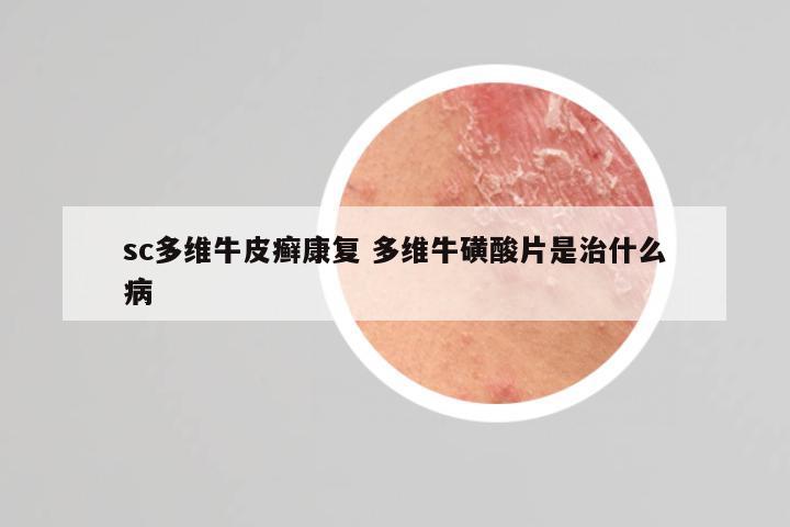 sc多维牛皮癣康复 多维牛磺酸片是治什么病