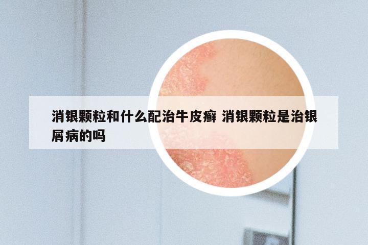 消银颗粒和什么配治牛皮癣 消银颗粒是治银屑病的吗