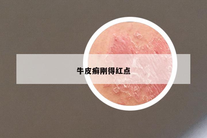 牛皮癣刚得红点