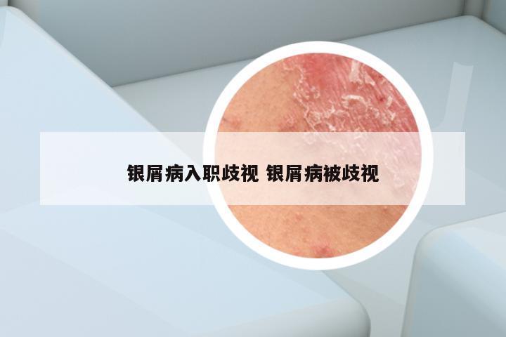 银屑病入职歧视 银屑病被歧视