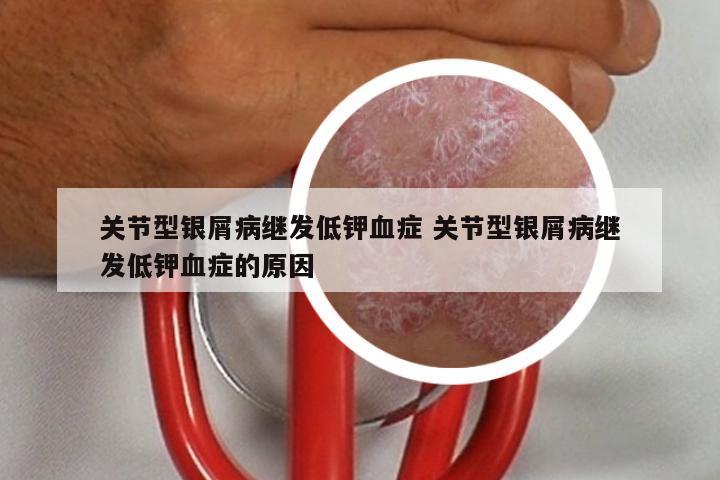 关节型银屑病继发低钾血症 关节型银屑病继发低钾血症的原因