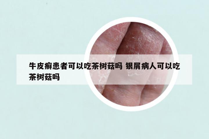 牛皮癣患者可以吃茶树菇吗 银屑病人可以吃茶树菇吗