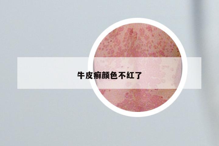 牛皮癣颜色不红了