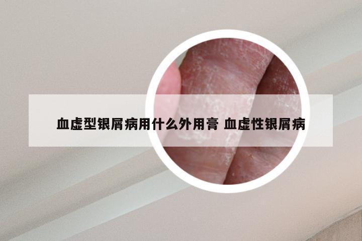 血虚型银屑病用什么外用膏 血虚性银屑病