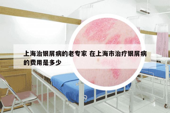 上海治银屑病的老专家 在上海市治疗银屑病的费用是多少