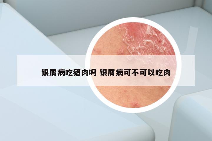 银屑病吃猪肉吗 银屑病可不可以吃肉