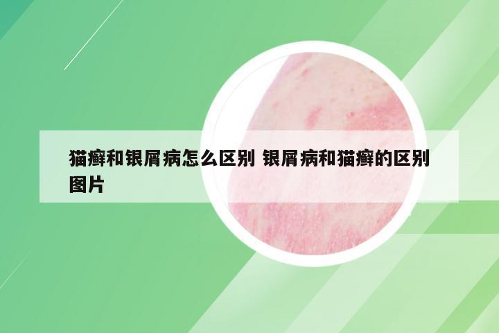 猫癣和银屑病怎么区别 银屑病和猫癣的区别图片