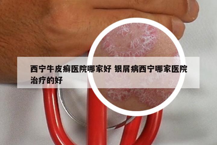 西宁牛皮癣医院哪家好 银屑病西宁哪家医院治疗的好