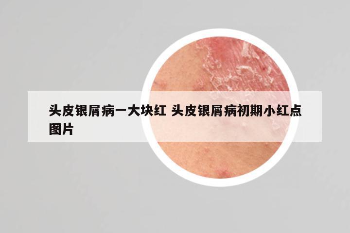 头皮银屑病一大块红 头皮银屑病初期小红点图片