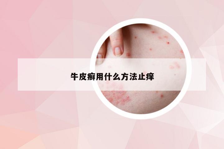 牛皮癣用什么方法止痒