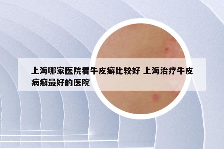 上海哪家医院看牛皮癣比较好 上海治疗牛皮病癣最好的医院