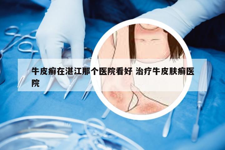 牛皮癣在湛江那个医院看好 治疗牛皮肤癣医院
