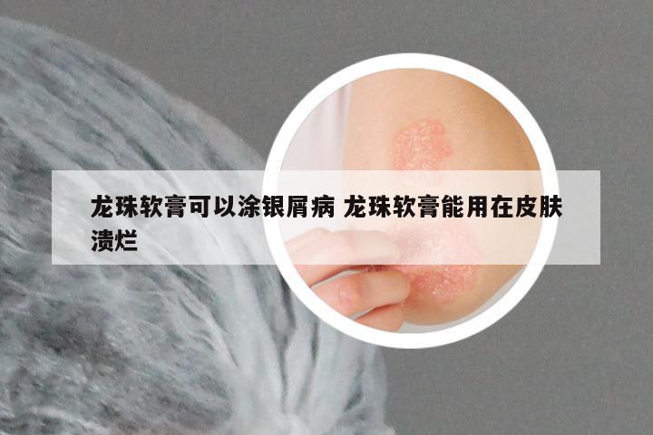 龙珠软膏可以涂银屑病 龙珠软膏能用在皮肤溃烂