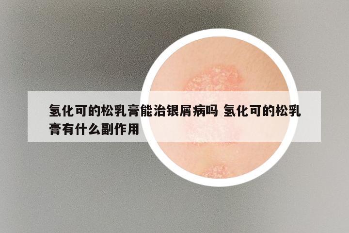 氢化可的松乳膏能治银屑病吗 氢化可的松乳膏有什么副作用