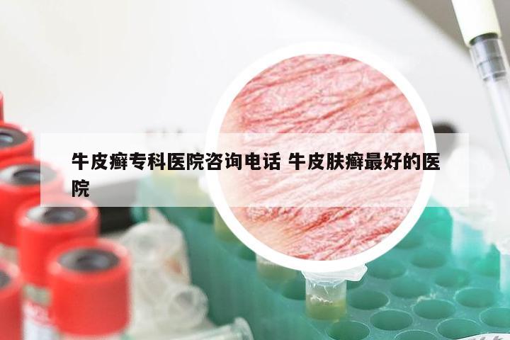 牛皮癣专科医院咨询电话 牛皮肤癣最好的医院