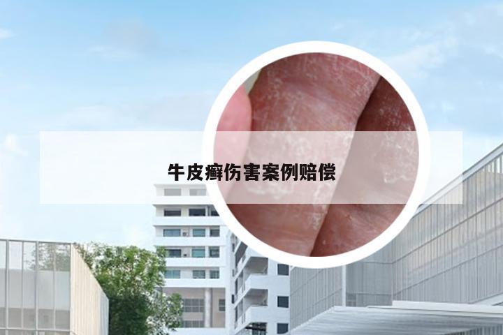 牛皮癣伤害案例赔偿