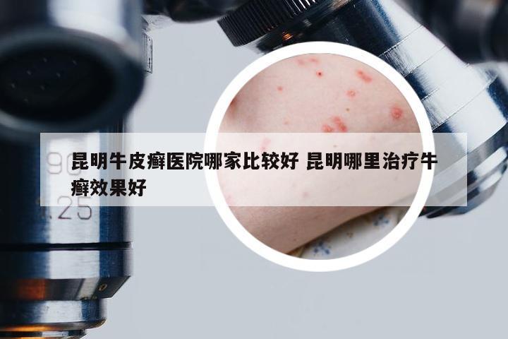 昆明牛皮癣医院哪家比较好 昆明哪里治疗牛癣效果好