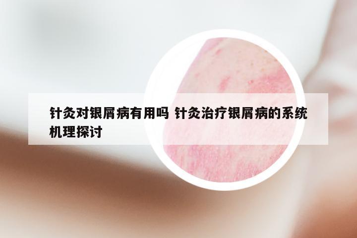 针灸对银屑病有用吗 针灸治疗银屑病的系统机理探讨
