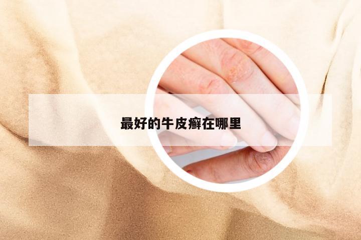 最好的牛皮癣在哪里